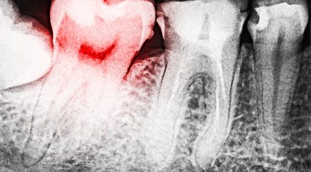 Scary Dental Xray