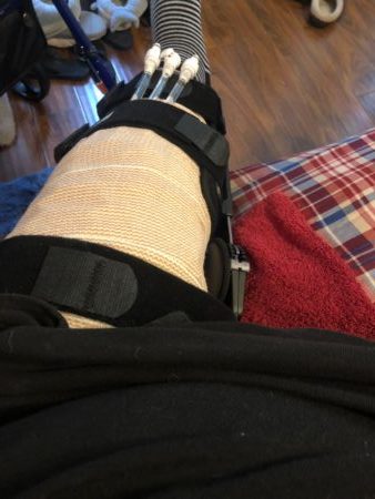 ACL Post-Op 2 hours